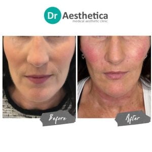 Side by side of a woman before and after receiving a full non surgical facelift at our birmingham clinic