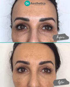 A woman before and after she received a full non surgical facelift at dr aesthetica birmingham