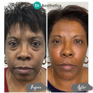 A before and after of a female patient who received a non surgical facelift at Dr Aesthetica's Brimingham Clinic.