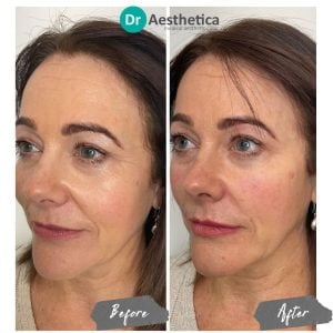 A before and after of a female patient who received a non surgical facelift at Dr Aesthetica's Brimingham Clinic.