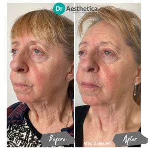 Before and after of a female patient who received a full non surgical facelift at dr aestheticas bimringham clinic
