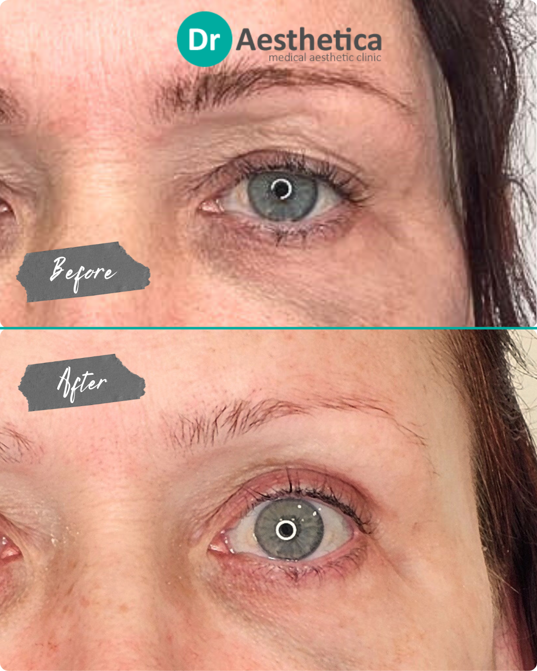 A before-and-after comparison of a woman's eyes showing a significant reduction in dark circles and fine lines below the lower eyelids after three E50 Exosome treatments.