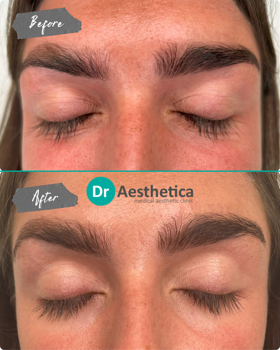 A side-by-side comparison showing a refreshed eye appearance with less sagging in the upper lids and significantly smoother skin texture around the orbital area.